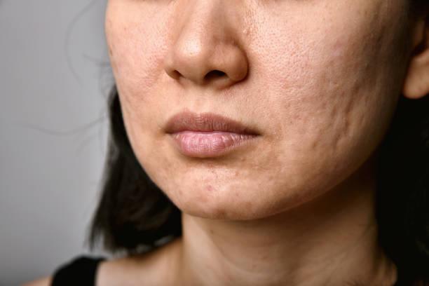 Do Chemical Peels Help With Acne Scars​?