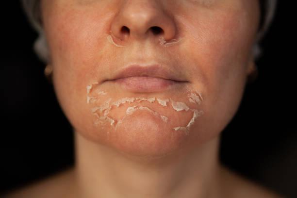 Hydrafacial Vs Chemical Peel