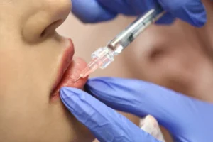 Lip Filler San Marcos
